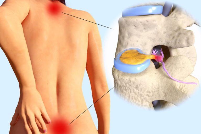 inversion tables vs professional spinal decompression